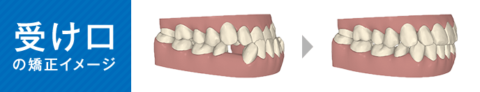 受け口の矯正イメージ
