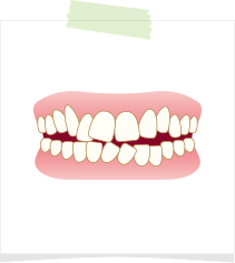 ガタガタの歯