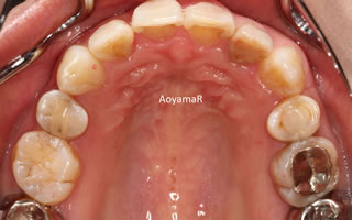 上下歯列の重度の叢生