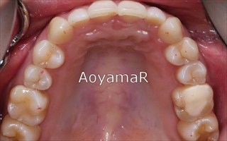 上下顎臼歯部における重度の叢生、交差咬合、上顎左側Ⅱ級