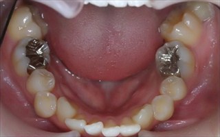 上下顎臼歯部における重度の叢生、交差咬合、上顎左側Ⅱ級