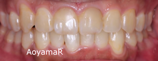上下歯列の重度の叢生