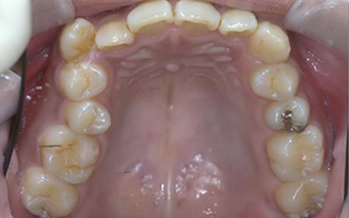 上下歯列の重度の叢生