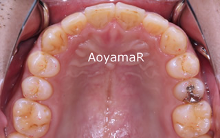 上下歯列の重度の叢生