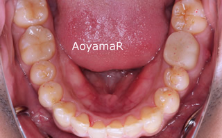 上下歯列の重度の叢生