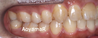 上下歯列の重度の叢生