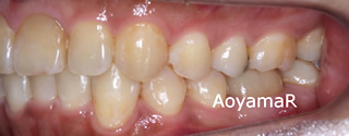 上下歯列の重度の叢生