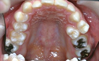 上下顎歯列に重度の叢生を伴う下顎前突