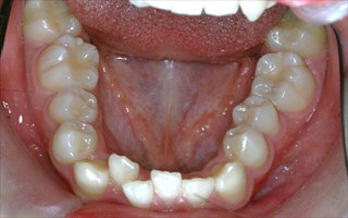 上下顎歯列に重度の叢生を伴う下顎前突