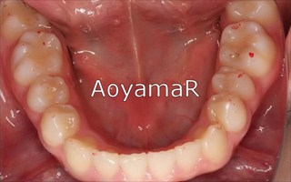 上下顎歯列に重度の叢生を伴う下顎前突