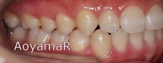 上下顎歯列に重度の叢生を伴う下顎前突