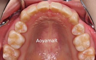 上下顎の歯列重度の叢生、臼歯の交差咬合