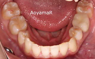 上下顎の歯列重度の叢生、臼歯の交差咬合