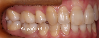 上下顎の歯列重度の叢生、臼歯の交差咬合