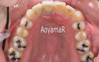 上顎歯列における重度の叢生