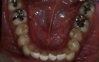 上顎歯列における重度の叢生