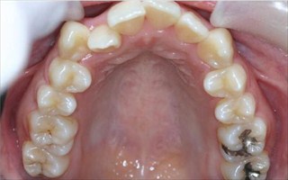 上下顎歯列における中等度の叢生