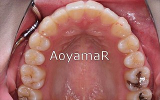 上下顎歯列における中等度の叢生