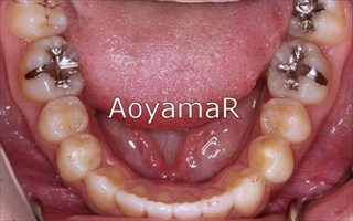 上下顎歯列における中等度の叢生