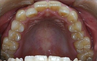 上下顎歯列における中等度の叢生