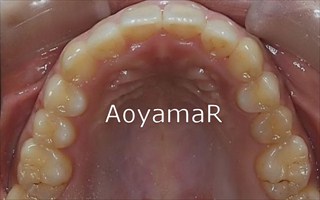 上下顎歯列における中等度の叢生