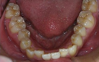 上下顎歯列における中等度の叢生