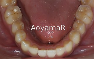 上下顎歯列における中等度の叢生