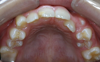 上顎大臼歯近心萌出、上顎左側側切歯舌側転位による重度の叢生