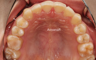 上顎大臼歯近心萌出、上顎左側側切歯舌側転位による重度の叢生