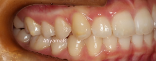 上顎大臼歯近心萌出、上顎左側側切歯舌側転位による重度の叢生