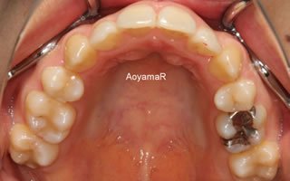 上下歯列の重度の叢生