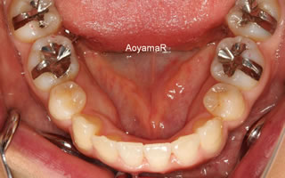 上下歯列の重度の叢生