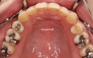 上下歯列の重度の叢生