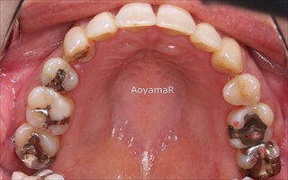 上顎歯列の狭窄、近心位を伴う重度の叢生両側Ⅱ級咬合