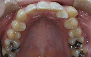 上下顎歯列における重度の叢生