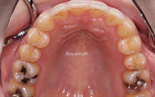 上下顎歯列における重度の叢生