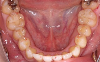 上下顎歯列における重度の叢生