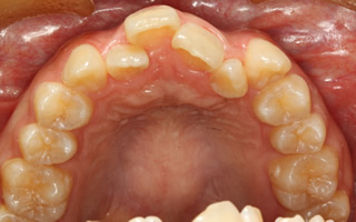 上下顎歯列重度の叢生、前歯部反対咬合
