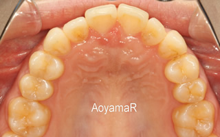 上下顎歯列重度の叢生、前歯部反対咬合