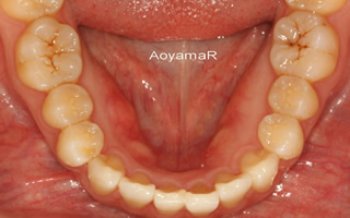 上下顎歯列重度の叢生、前歯部反対咬合