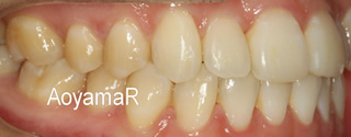 上下顎歯列重度の叢生、前歯部反対咬合