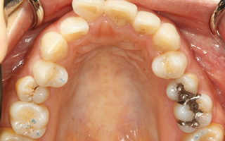 上下顎歯列における重度の叢生