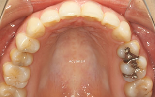 上下顎歯列における重度の叢生