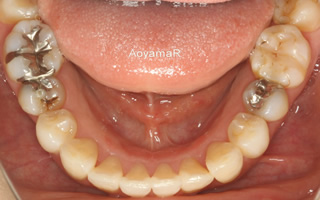 上下顎歯列における重度の叢生