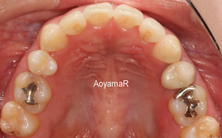 上下歯列の重度の叢生