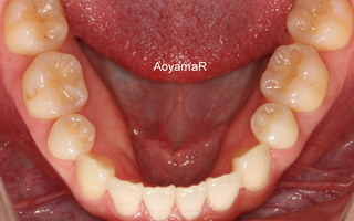 上下歯列の重度の叢生