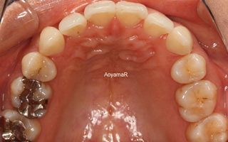 上下顎左右側犬歯低位唇側転位を伴う上下歯列重度の叢生