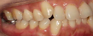上下顎左右側犬歯低位唇側転位を伴う上下歯列重度の叢生