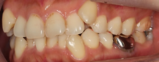 上下顎左右側犬歯低位唇側転位を伴う上下歯列重度の叢生