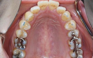 上顎歯列狭窄による上顎両側中切歯の唇側傾斜